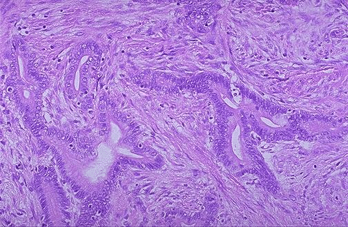 Tipos de neoplasias de intestino grueso Tipos de neoplasias de intestino grueso