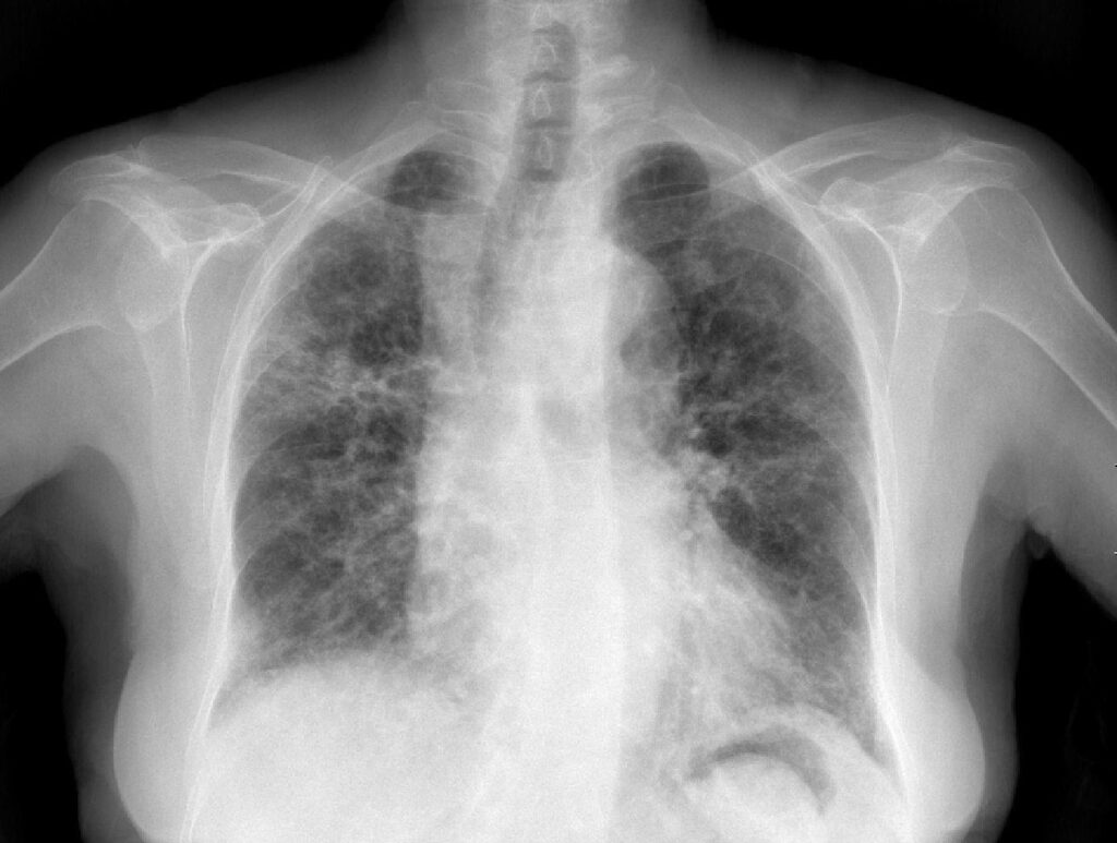 Tratamiento de la neumonitis por hipersensibilidad