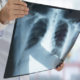¿Qué es la Tuberculosis pleural?