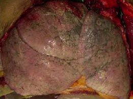 ¿Qué color tienen los pulmones?