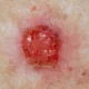 ¿Cuál es el cáncer cutáneo más frecuente?