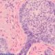 ¿Cómo se clasifica los carcinomas de células basales?