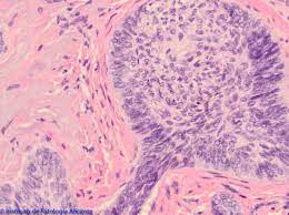 ¿Cómo se clasifica los carcinomas de células basales?