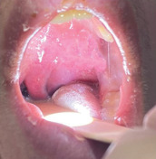 ¿Que es la infección periamigdalina?