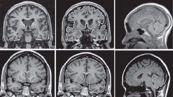 ¿Qué es la enfermedad de Huntington? ¿Qué es la enfermedad de Huntington?