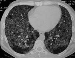 ¿Qué es la enfermedad pulmonar intersticial? ¿Qué es la enfermedad pulmonar intersticial?