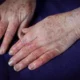 ¿Qué es la tromboangeitis obliterante?