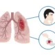 Identificación del origen anatómico de la hemoptisis