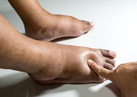 Exploración física en pacientes con edema de miembros inferiores