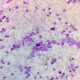 ¿Cuáles son los hallazgos clínicos de la trombocitosis esencial?