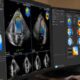 Ecocardiografía de estrés en pacientes con dolor torácico