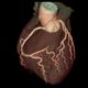 Angiografía coronaria por TC en pacientes con dolor torácico