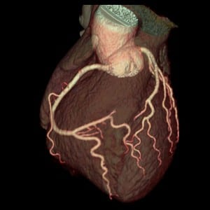 Angiografía coronaria por TC en pacientes con dolor torácico