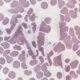 ¿Qué es la crioglobulinemia?
