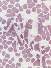 ¿Qué es la crioglobulinemia?