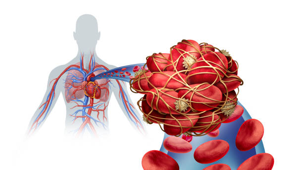 Factores de riesgo de la embolia pulmonar