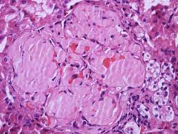 ¿Qué es la amiloidosis renal?