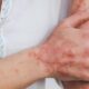 La sarna es una infestación parasitaria