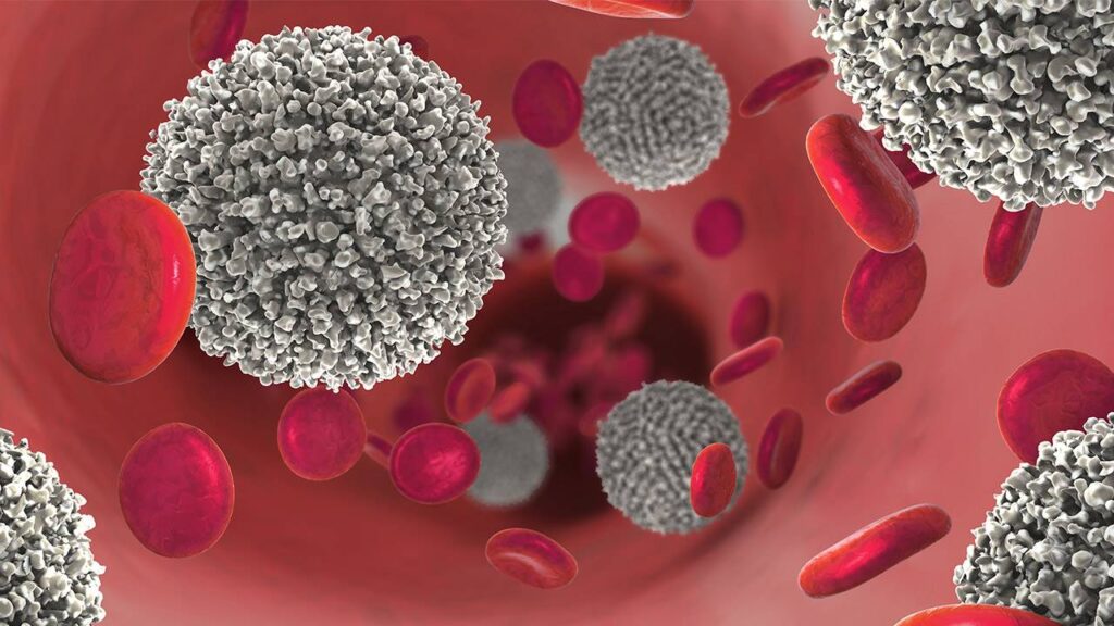¿Cuáles son las causas de leucemia aguda?