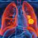 El cáncer de pulmón es la neoplasia que ocasiona más muertes