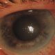 Causas de glaucoma primario de ángulo cerrado agudo