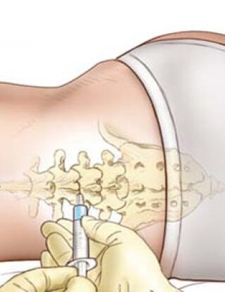 Ventajas y desventajas de la administración intratecal de medicamentos