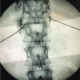 Bloqueo y neurolisis del plexo celíaco
