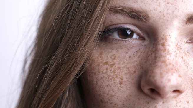 Pecas y léntigos