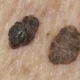 ¿Qué es la queratosis seborreica?