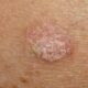 ¿Qué es la queratosis actínica?