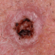 ¿Por qué aparece el carcinoma de células escamosas?
