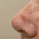 Tratamiento del carcinoma de células escamosas de la piel