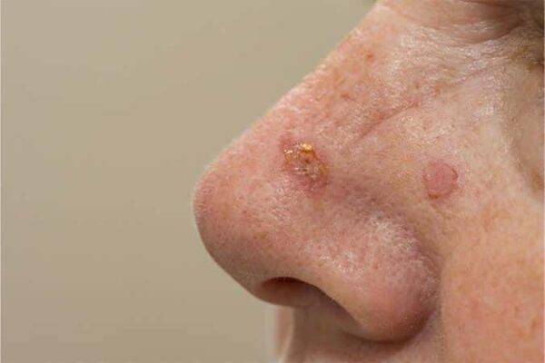 Tratamiento del carcinoma de células escamosas de la piel