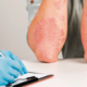 Generalidades de las infecciones fúngicas