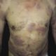 La micosis fungoides es un linfoma cutáneo de células T