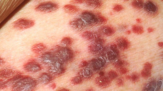 El virus herpes simple 8 causa sarcoma de Kaposi