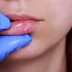 Tratamiento sistémico contra la infección por herpes simple