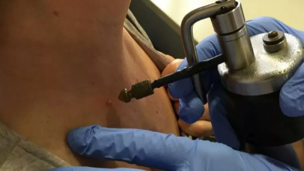 Tratamiento de las verrugas no genitales