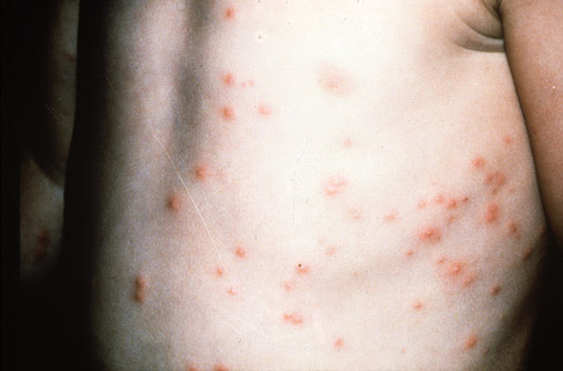 La foliculitis del jacuzzi (foliculitis por Pseudomonas)