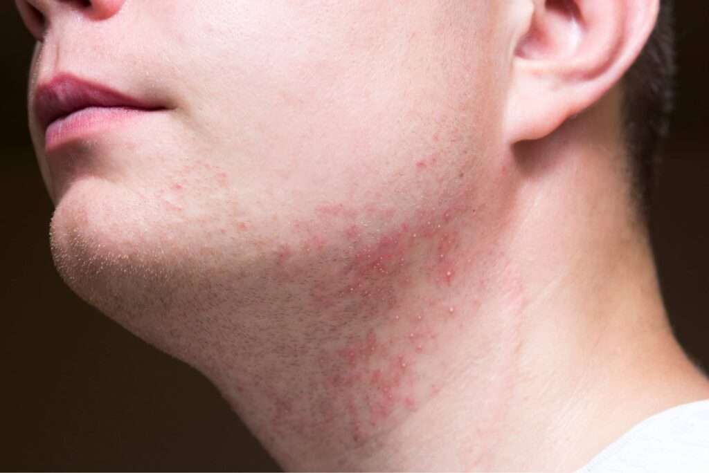 Foliculitis no bacteriana