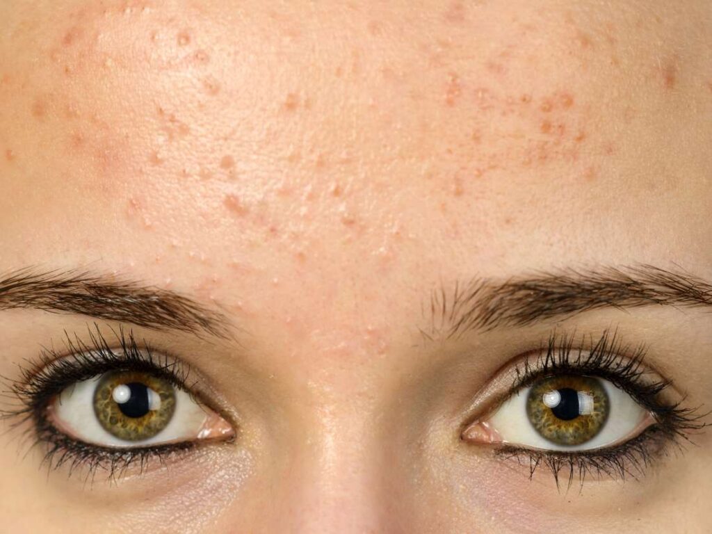 ¿Qué es la foliculitis por Pityrosporum?