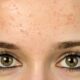 ¿Qué es la foliculitis por Pityrosporum?