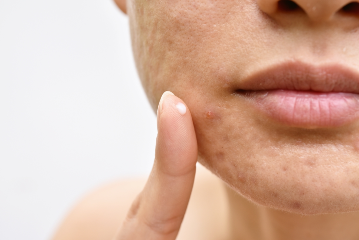 ¿Cuáles son los síntomas de foliculitis?