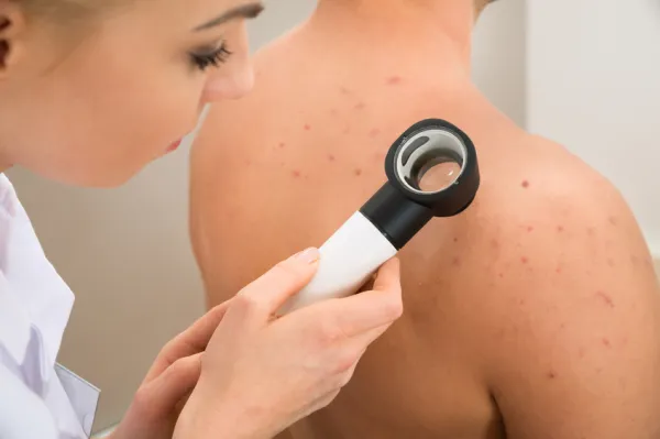 Diagnóstico diferencial de la foliculitis