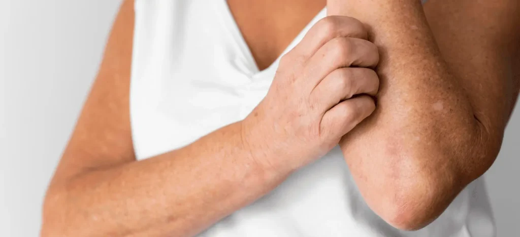 Medidas generales en el tratamiento de la dermatitis atópica