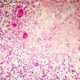 Morfología de la lesión neuronal subaguda y crónica
