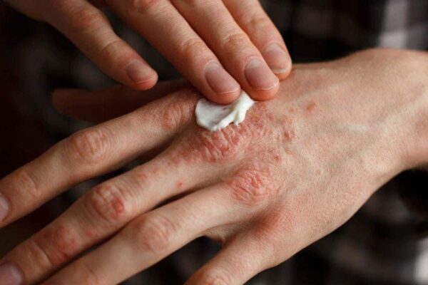 Tratamiento tópico de la dermatitis atópica