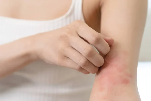 Tratamiento sistémico de la dermatitis atópica