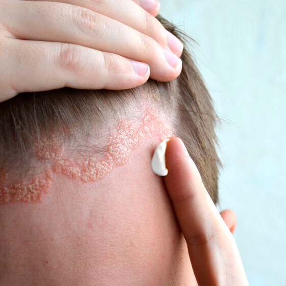 Dermatitis seborreica