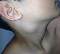 Las adenopatias cervicales indican cancer o infección